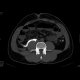 Fracture of the transverse process of lumbar vertebra: CT - Computed tomography